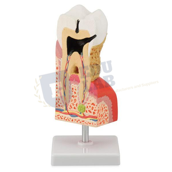 Lower Molar With Caries